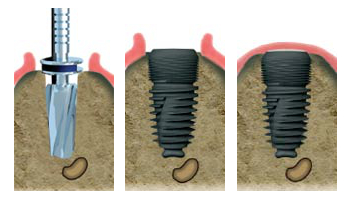 Spécialiste implant dentaire Montreuil