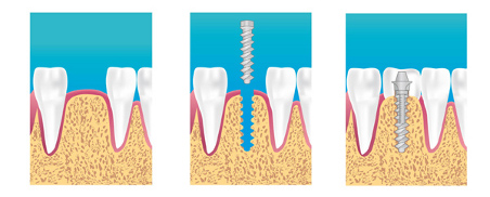 Implants dentaires à Montreuil